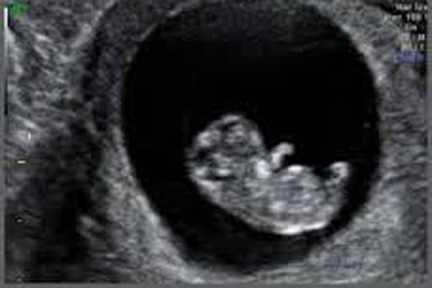 anencephaly ultrasound 9 weeks